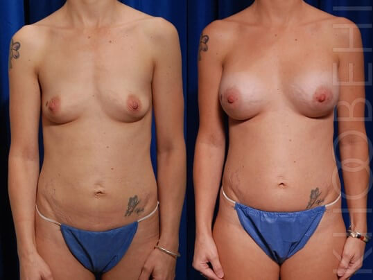 Dr. Khoobehi Patient: Before and After Breast Augmentation 1