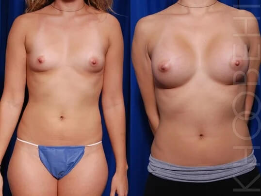 Dr. Khoobehi Patient: Before and After Breast Augmentation 2