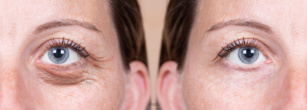 Before and after photo of a woman who received blepharoplasty.