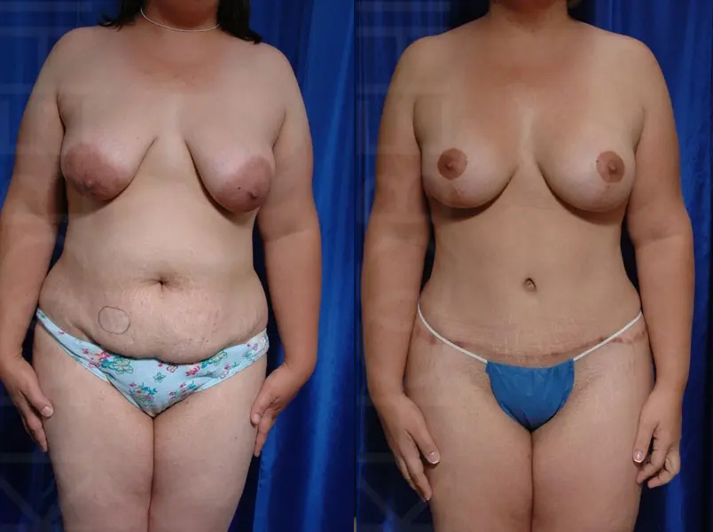 breast lift before and after photo three