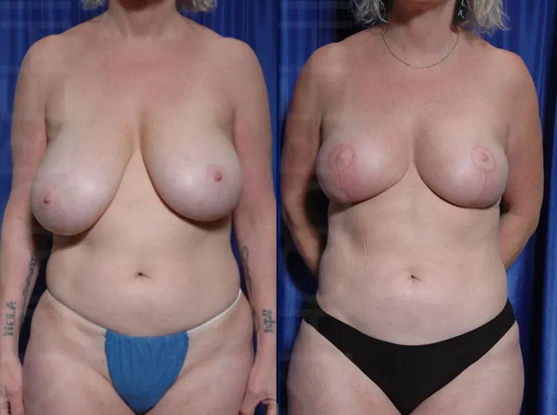 breast lift before and after photo one