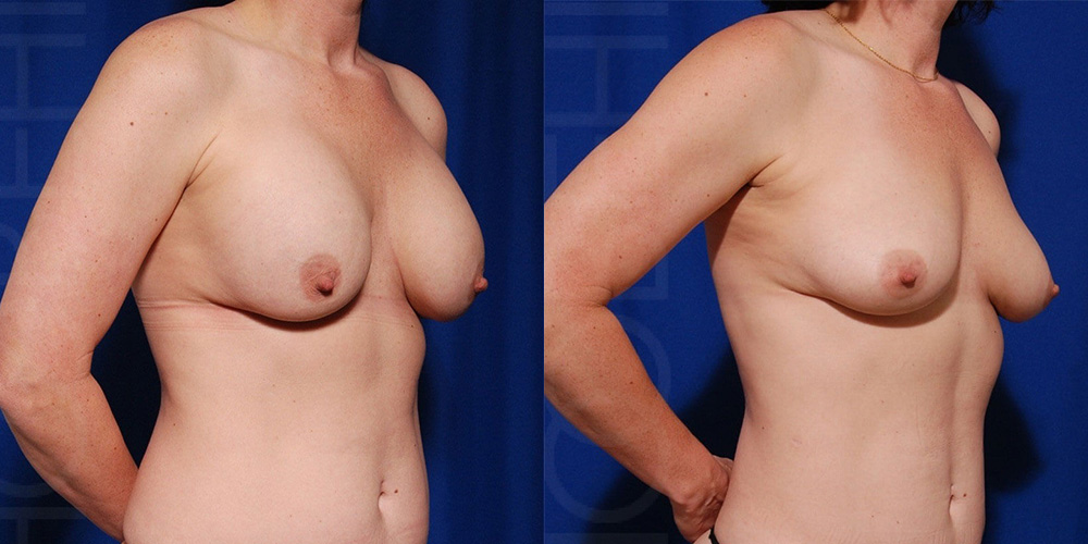 Actual Patient Results 4
