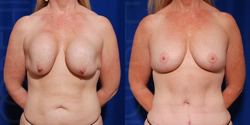 Female before and after implant removal with fat augmentation